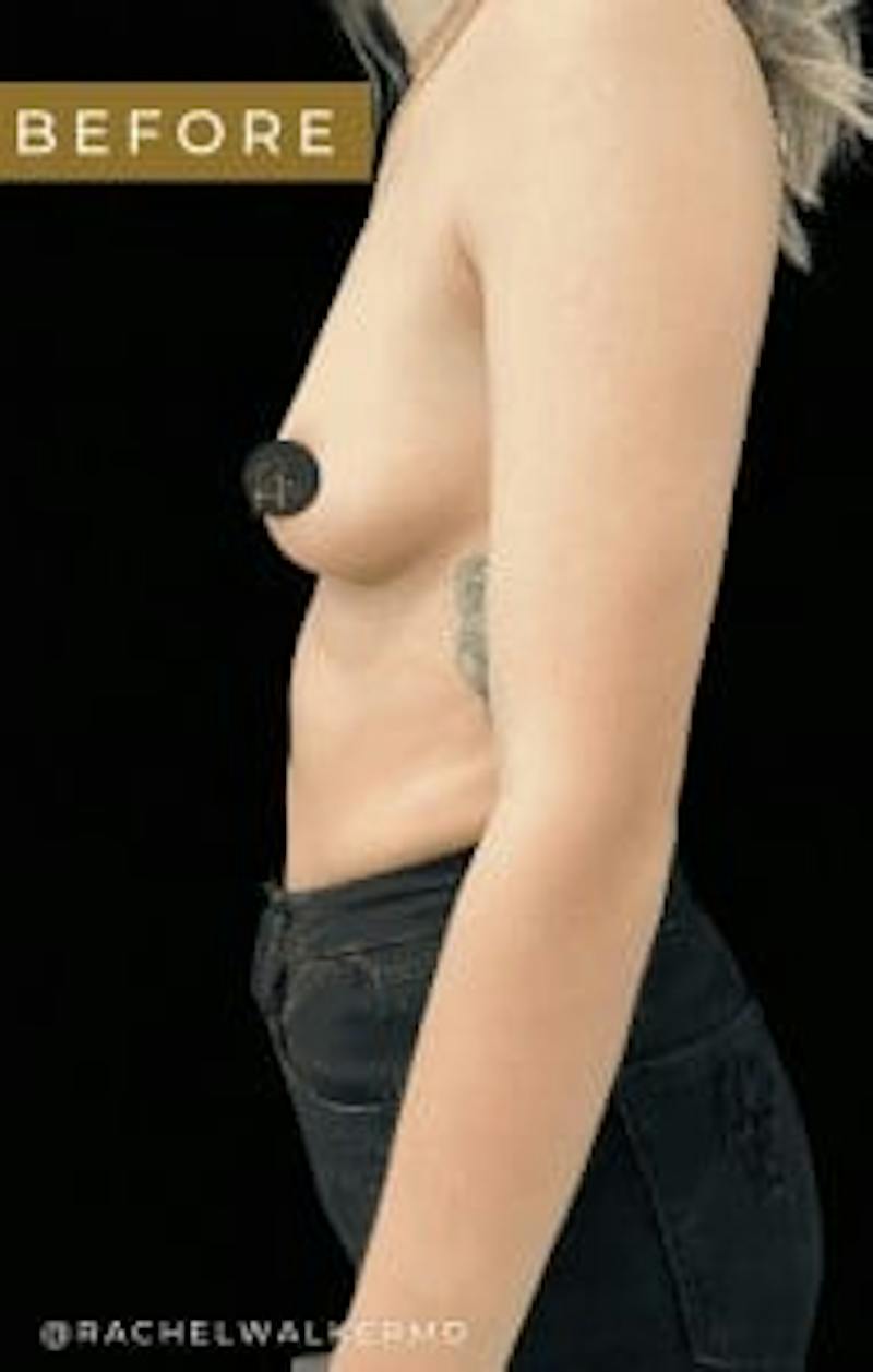 Breast Augmentation Before & After Gallery - Patient 388765 - Image 1