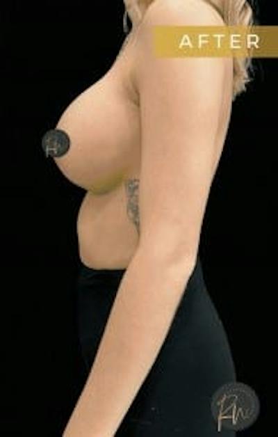 Breast Augmentation Before & After Gallery - Patient 388765 - Image 2