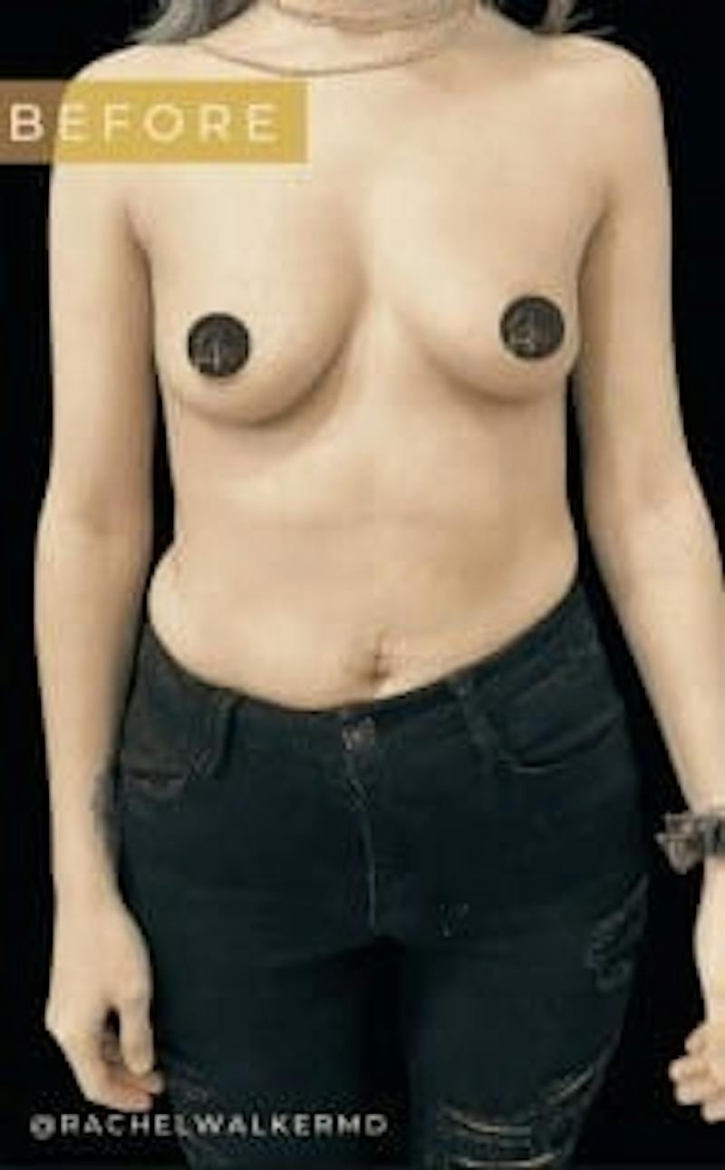 Breast Augmentation Before & After Gallery - Patient 388765 - Image 3