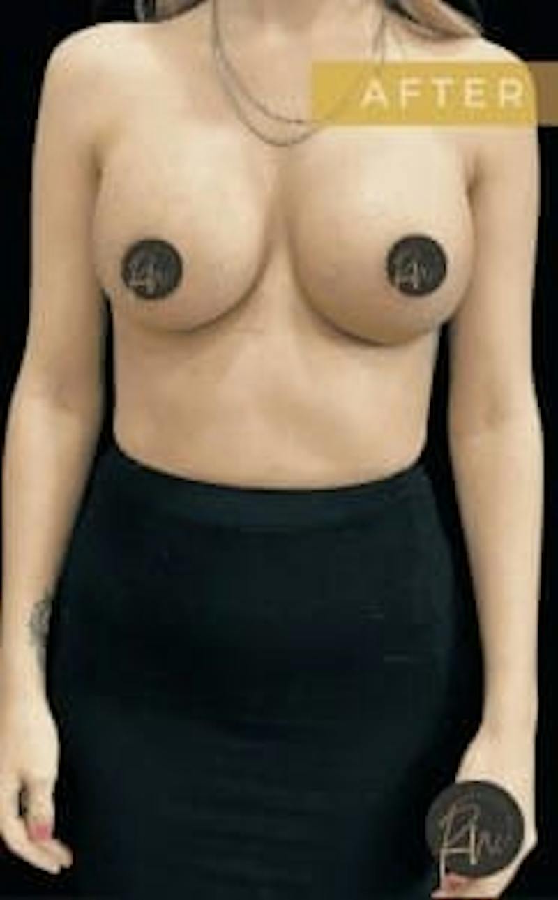 Breast Augmentation Before & After Gallery - Patient 388765 - Image 4