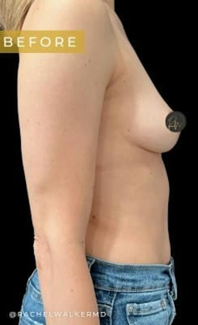 Breast Augmentation Before & After Gallery - Patient 313348 - Image 1