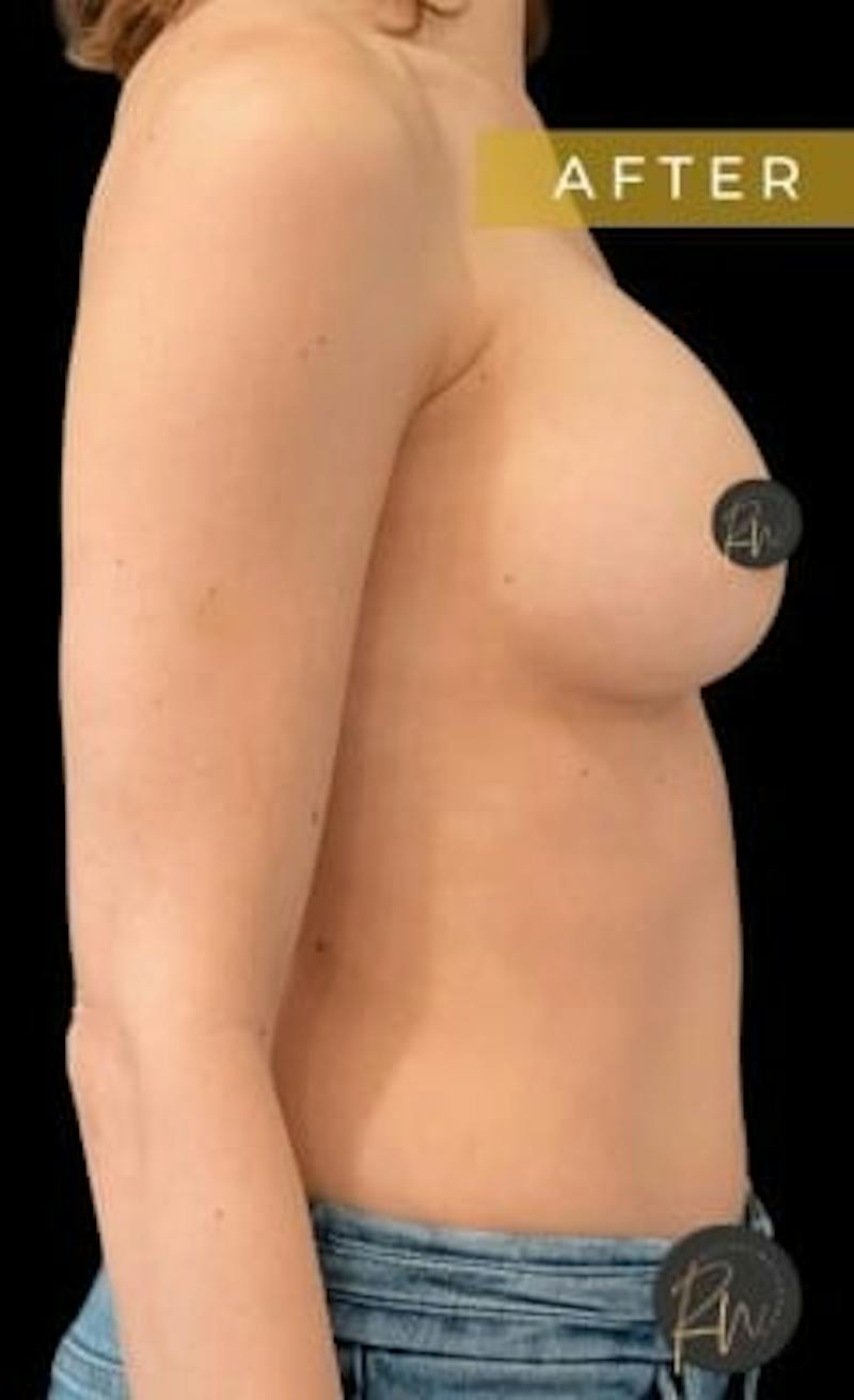 Breast Augmentation Before & After Gallery - Patient 313348 - Image 2