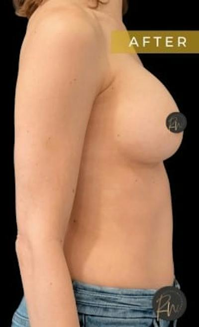 Breast Augmentation Before & After Gallery - Patient 313348 - Image 2