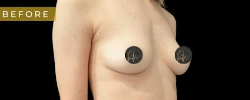Breast Augmentation Before & After Gallery - Patient 313348 - Image 3