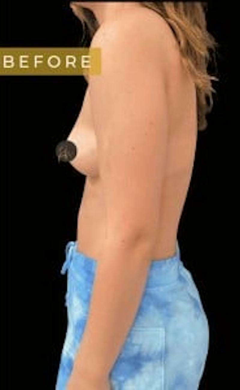 Breast Augmentation Before & After Gallery - Patient 179433 - Image 1