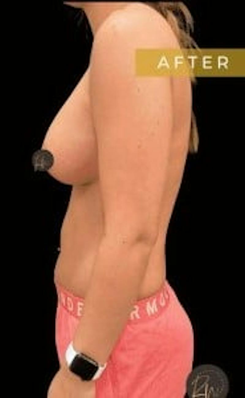 Breast Augmentation Before & After Gallery - Patient 179433 - Image 2