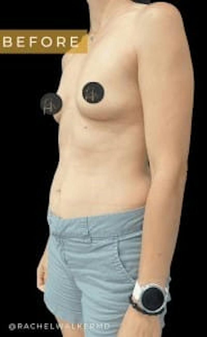 Breast Augmentation Before & After Gallery - Patient 272795 - Image 1