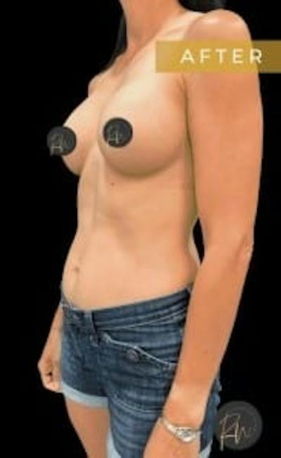 Breast Augmentation Before & After Gallery - Patient 272795 - Image 2