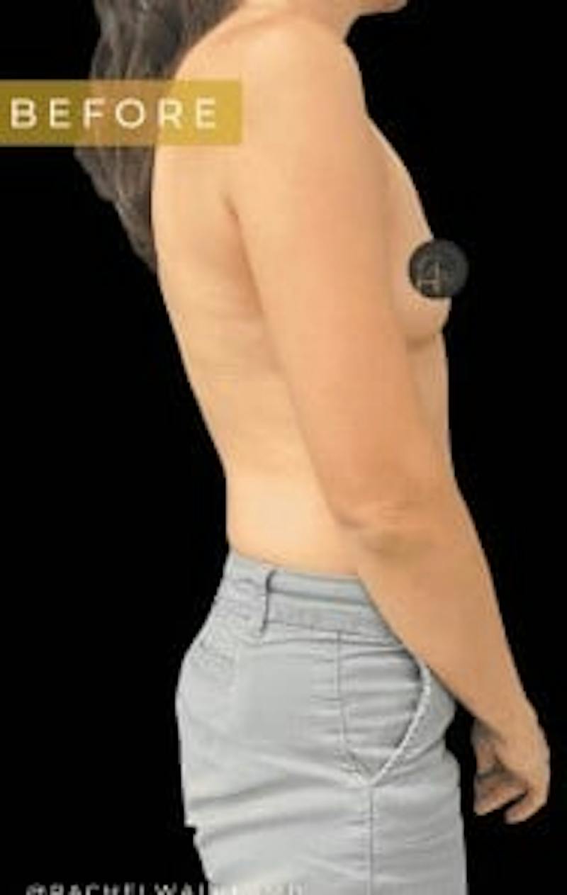 Breast Augmentation Before & After Gallery - Patient 272795 - Image 3