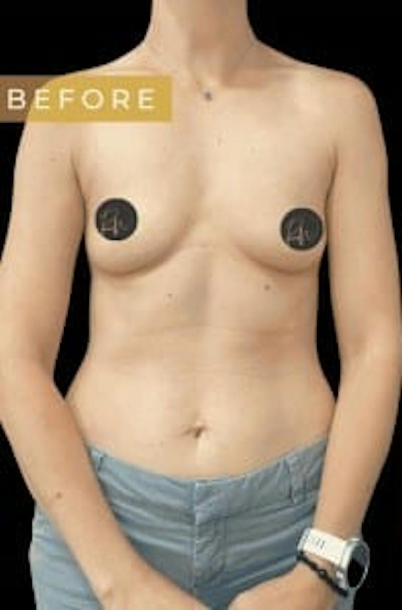 Breast Augmentation Before & After Gallery - Patient 272795 - Image 5