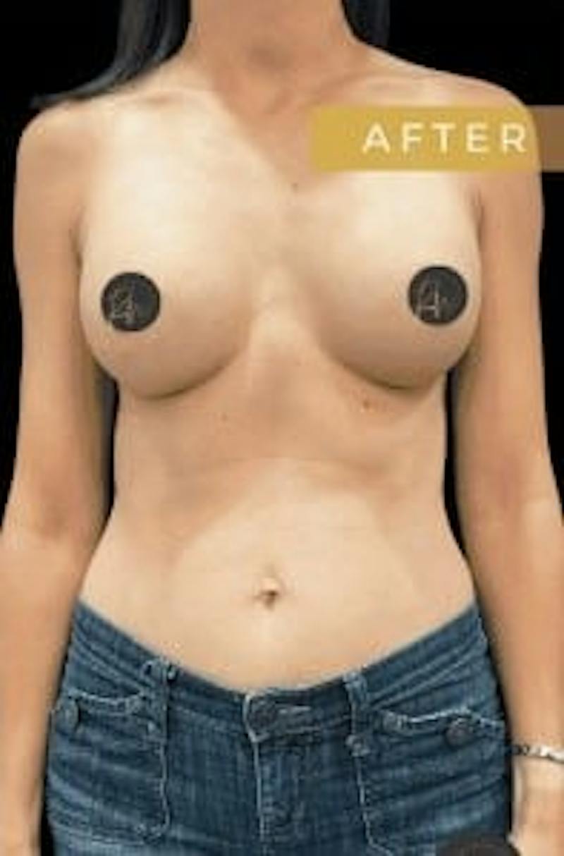 Breast Augmentation Before & After Gallery - Patient 272795 - Image 6