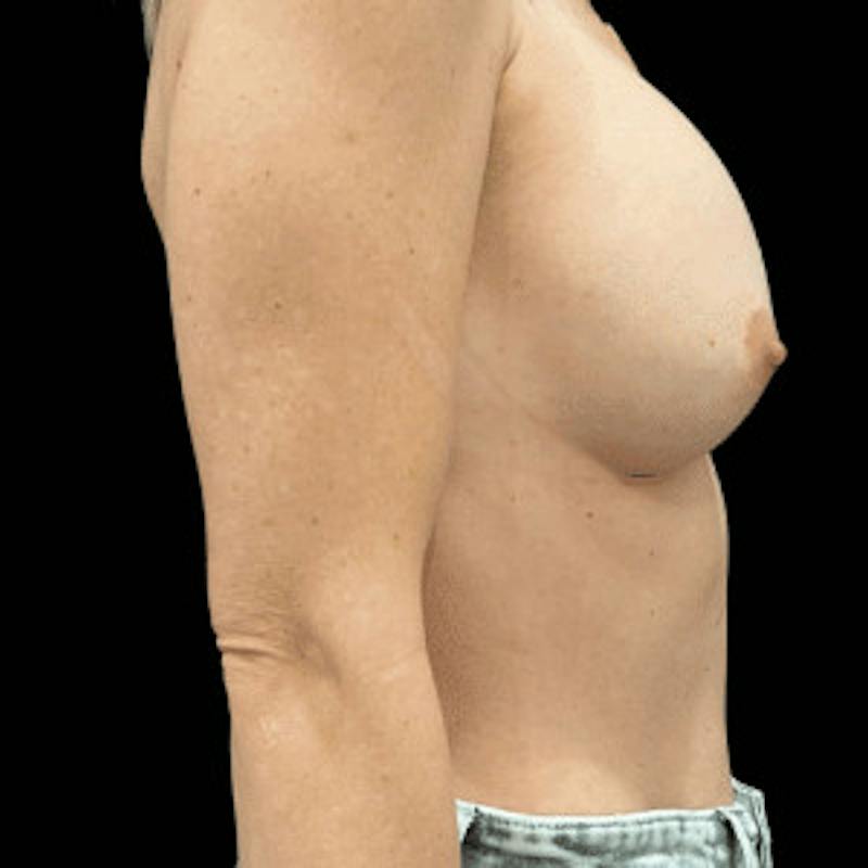 Breast Augmentation Before & After Gallery - Patient 224216 - Image 2