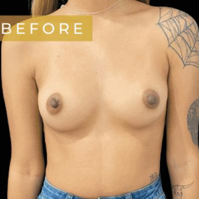 Breast Augmentation Before & After Gallery - Patient 161792 - Image 1