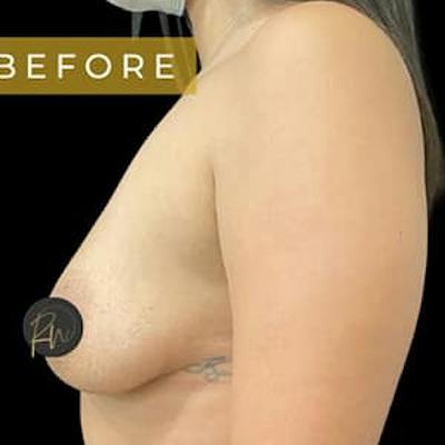 Breast Augmentation Before & After Gallery - Patient 262705 - Image 1