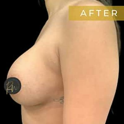 Breast Augmentation Before & After Gallery - Patient 262705 - Image 2