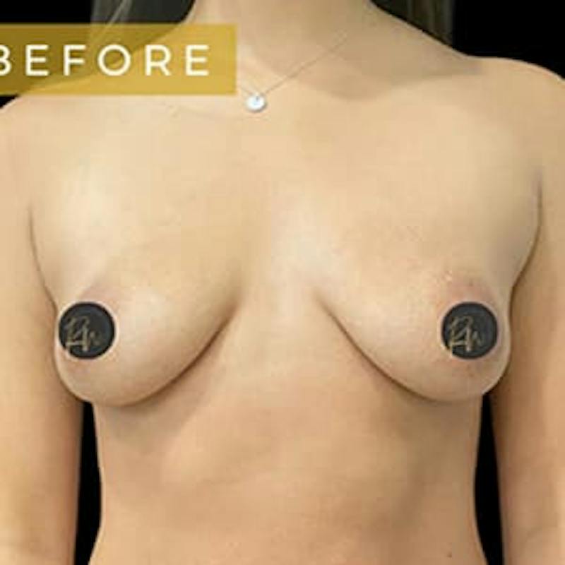Breast Augmentation Before & After Gallery - Patient 262705 - Image 3