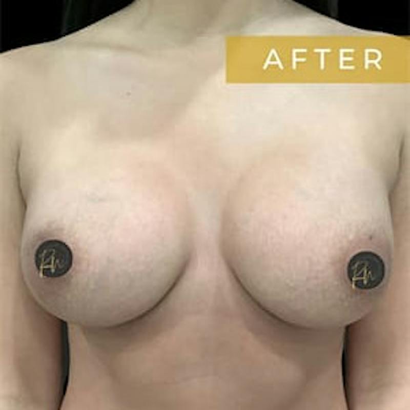 Breast Augmentation Before & After Gallery - Patient 262705 - Image 4