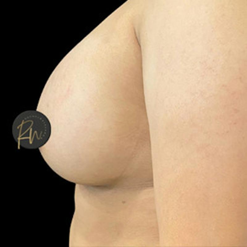 Breast Augmentation Before & After Gallery - Patient 288566 - Image 4