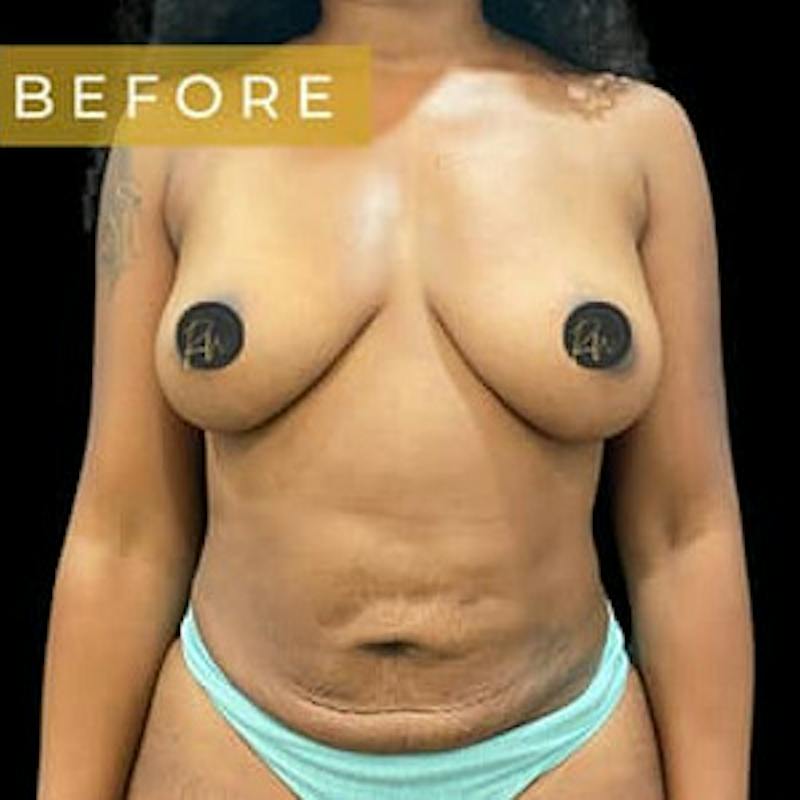 Breast Augmentation Before & After Gallery - Patient 291456 - Image 1