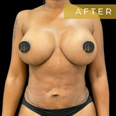 Breast Augmentation Before & After Gallery - Patient 291456 - Image 2