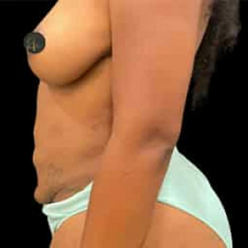 Breast Augmentation Before & After Gallery - Patient 291456 - Image 3