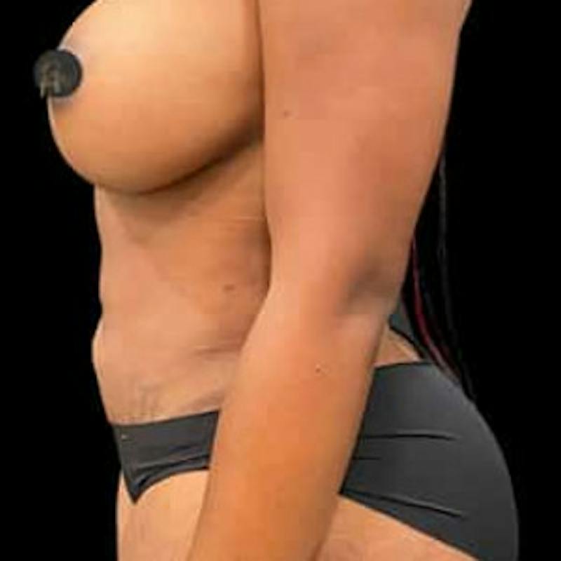 Breast Augmentation Before & After Gallery - Patient 291456 - Image 4