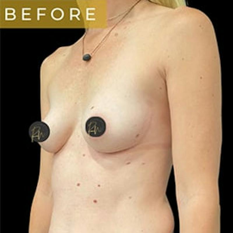 Breast Augmentation Before & After Gallery - Patient 344824 - Image 1