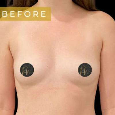 Breast Augmentation Before & After Gallery - Patient 353761 - Image 1