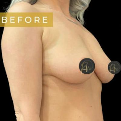 Breast Augmentation Before & After Gallery - Patient 100419 - Image 1