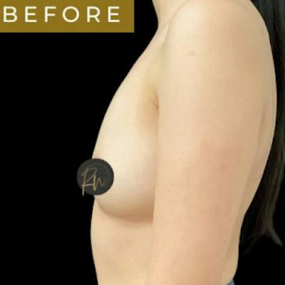 Breast Augmentation Before & After Gallery - Patient 148030 - Image 1