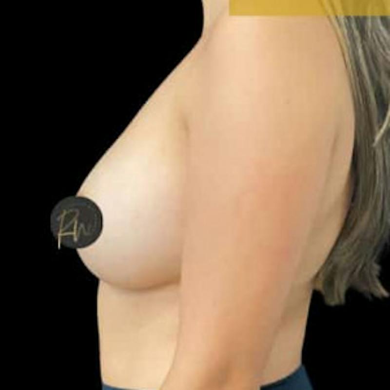 Breast Augmentation Before & After Gallery - Patient 148030 - Image 2