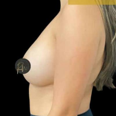 Breast Augmentation Before & After Gallery - Patient 148030 - Image 2