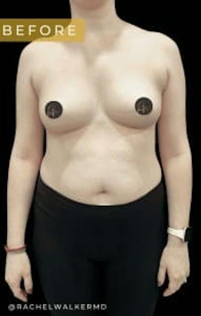 Breast Augmentation Before & After Gallery - Patient 342342 - Image 1