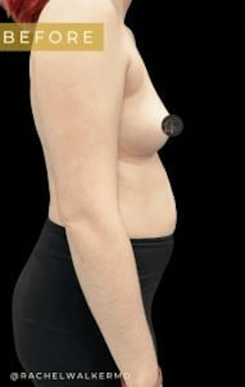 Breast Augmentation Before & After Gallery - Patient 342342 - Image 3
