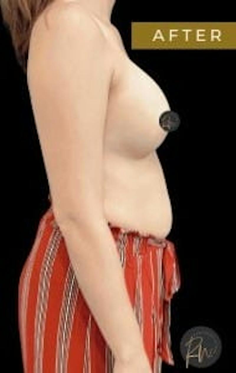 Breast Augmentation Before & After Gallery - Patient 342342 - Image 4