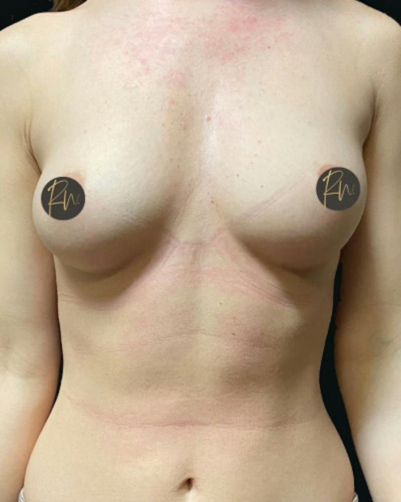 Breast Augmentation Before & After Gallery - Patient 245825 - Image 3