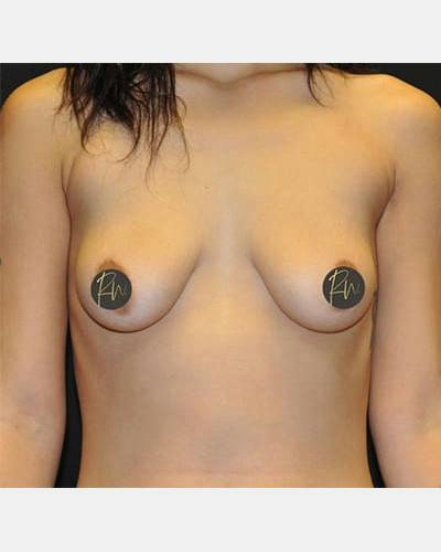 Breast Augmentation Before & After Gallery - Patient 203818 - Image 1