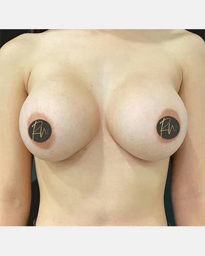 Breast Augmentation Before & After Gallery - Patient 203818 - Image 2