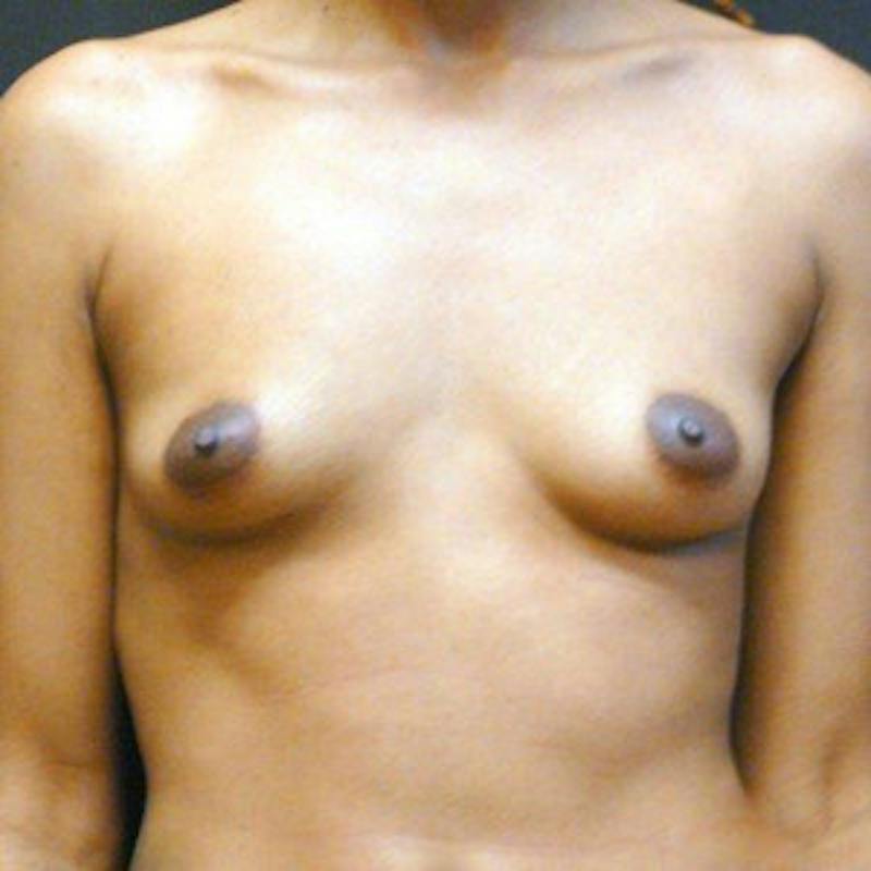 Breast Augmentation Before & After Gallery - Patient 103509 - Image 1