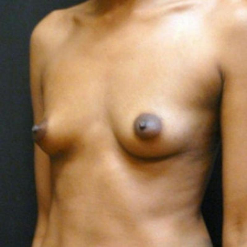 Breast Augmentation Before & After Gallery - Patient 103509 - Image 3