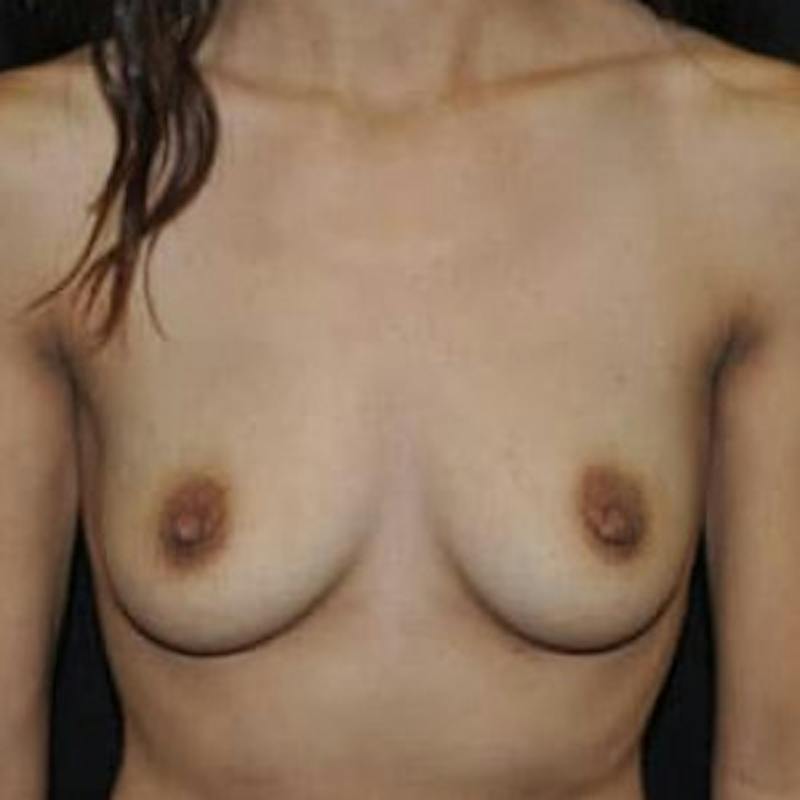 Breast Augmentation Before & After Gallery - Patient 417692 - Image 1