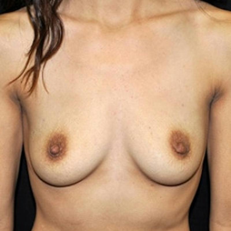 Breast Augmentation Before & After Gallery - Patient 151345 - Image 1