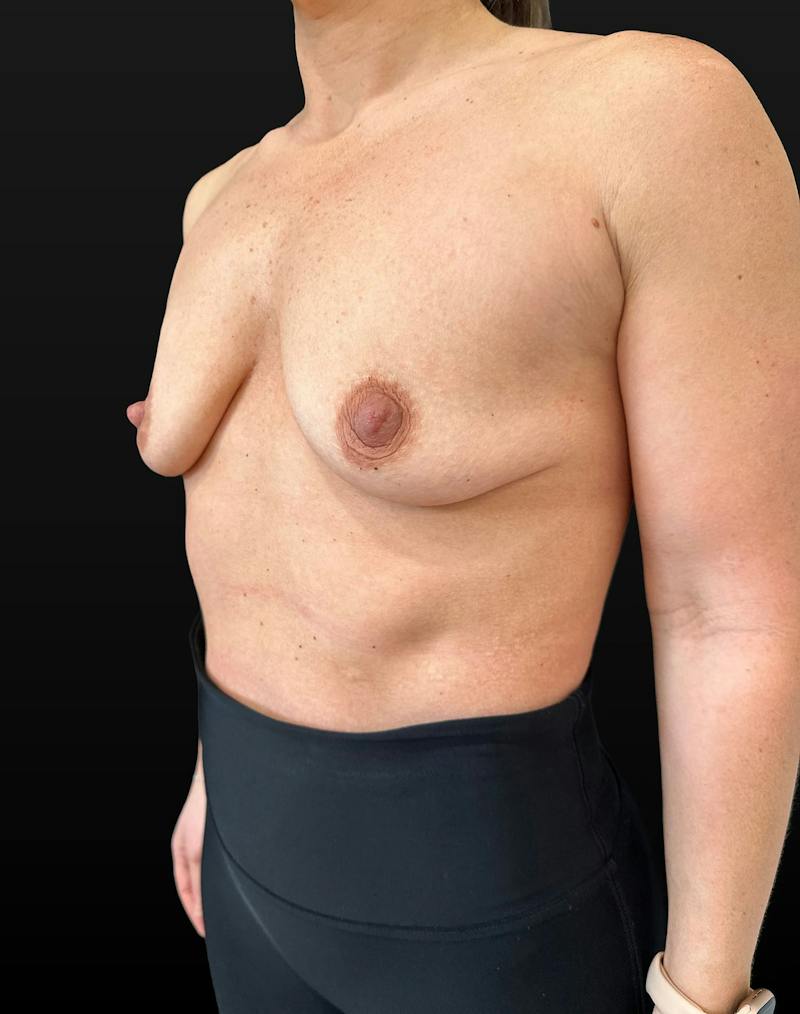 Breast Augmentation Before & After Gallery - Patient 142928 - Image 3
