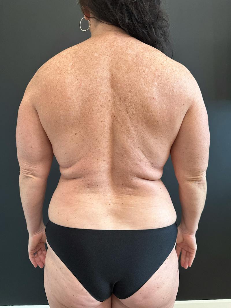 Breast Implant Exchange Before & After Gallery - Patient 236399 - Image 5