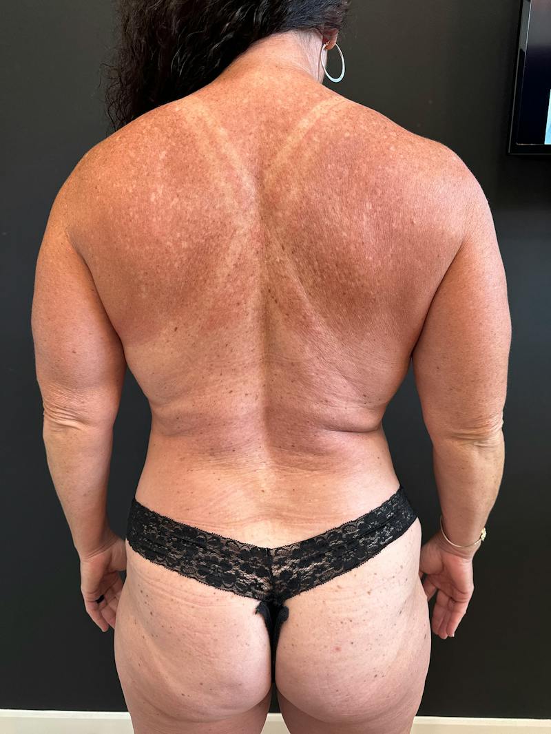 Breast Implant Exchange Before & After Gallery - Patient 236399 - Image 6