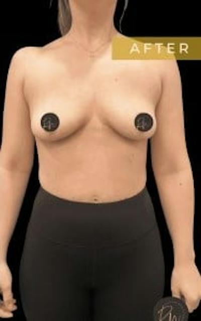 Breast Implant Removal Before & After Gallery - Patient 297066 - Image 2
