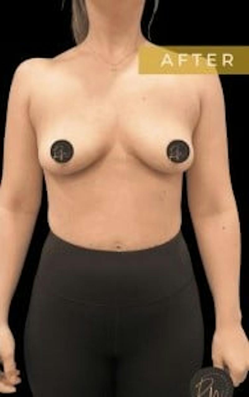 Breast Implant Removal Before & After Gallery - Patient 297066 - Image 2