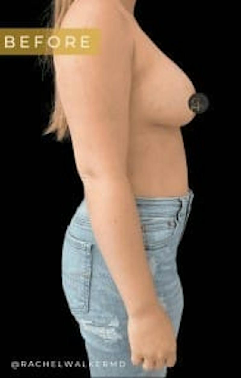 Breast Implant Removal Before & After Gallery - Patient 297066 - Image 3