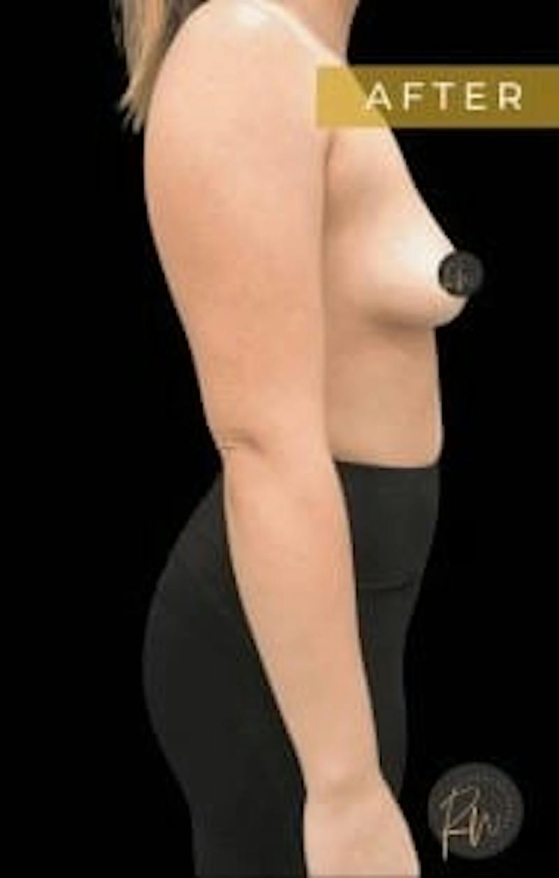 Breast Implant Removal Before & After Gallery - Patient 297066 - Image 4