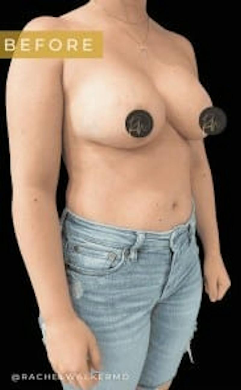 Breast Implant Removal Before & After Gallery - Patient 297066 - Image 5